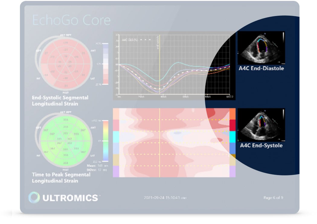 Achieving zero variability echocardiographic analysis in cardio-oncology  with AI-powered EchoGo from Ultromics - Ultromics