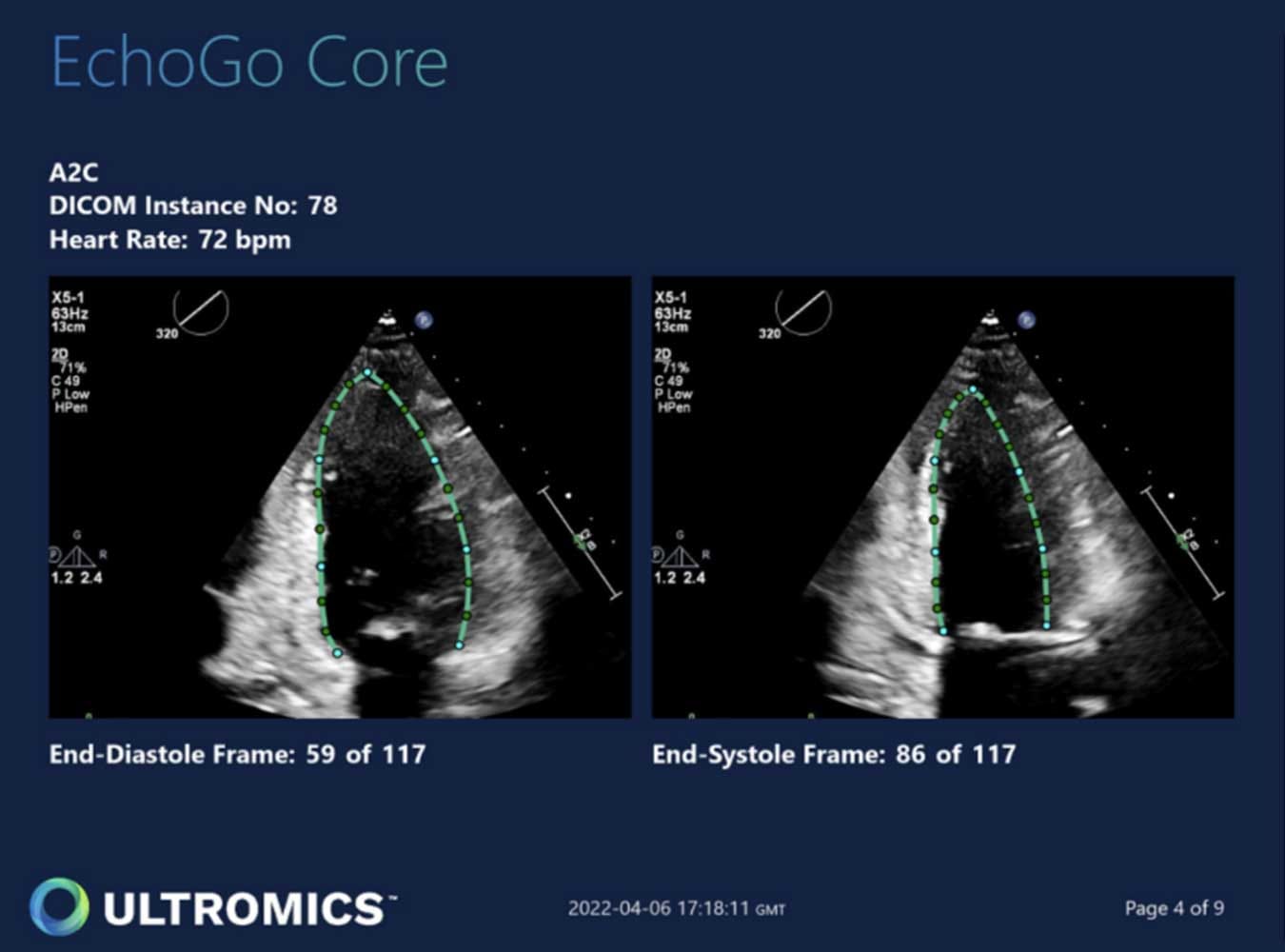 Achieving zero variability echocardiographic analysis in cardio-oncology  with AI-powered EchoGo from Ultromics - Ultromics